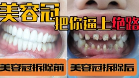 名医揭秘，牙齿矫正四大谣言真相揭秘